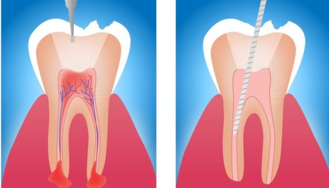 Endodontia e tratamento de canal é a mesma coisa