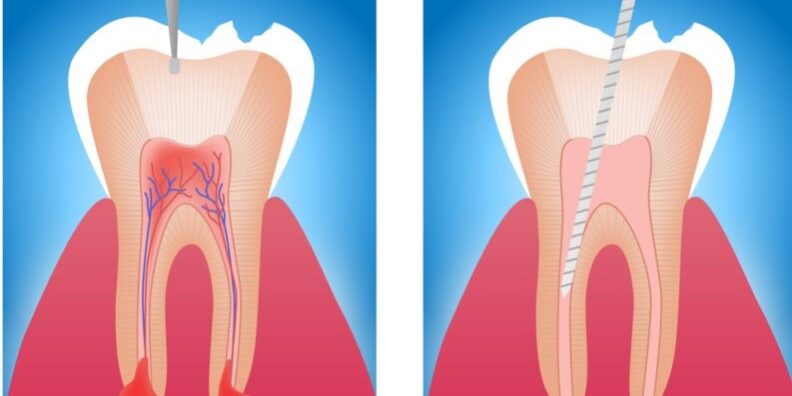 Endodontia e tratamento de canal é a mesma coisa