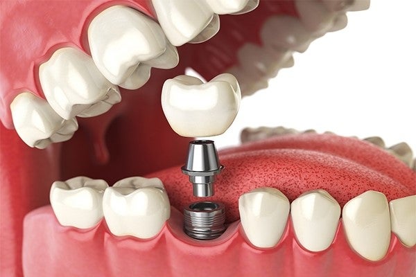 Implante dentário – Quais casos esse tratamento é indicado