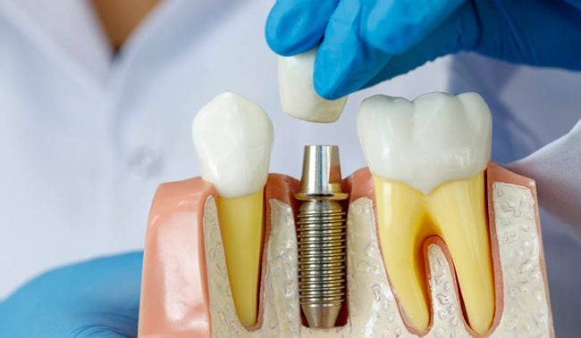 Doctor showing dental implant