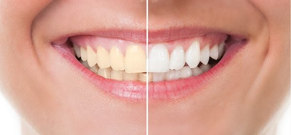 mitos-e-verdades-sobre-o-clareamento-dental