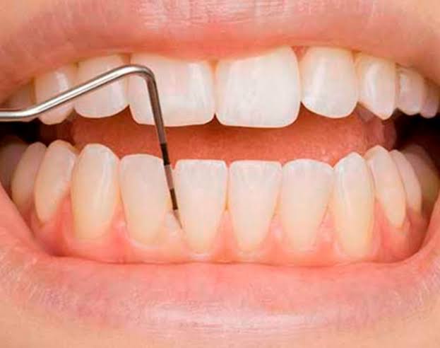 Periodontite- Sintomas e causas da doença