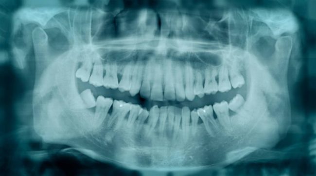 Dentes tortos- o que pode desencadeá-los e como resolver