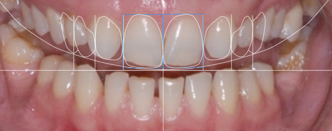 Implantodontia -planejamento estético do sorriso multidisciplinar