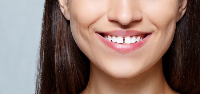Diastema frontal -tipos-de-tratamentos-no-consultorio-odontologico-no-ES