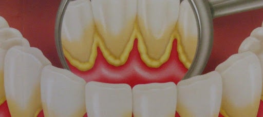 tartaro-nos-dentes-dicas-de-como-acabar-com-esse-problema-bucal-dentista-em-vitoria-es