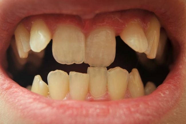 dentes-tortos-como-podem-afetar-a-saude-dentista-em-vitoria-es