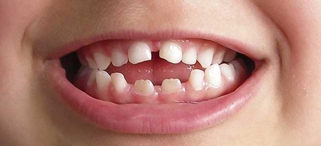 morida-aberta-anterior-consultorio-odontologico-em-vitoria-es
