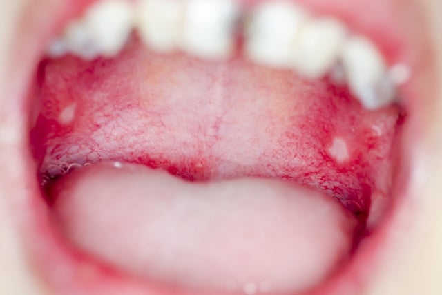 Mucosite na boca | Saiba quais os sintomas e tipos de tratamentos Mucosite na boca | Saiba quais os sintomas e tipos de tratamentos