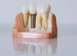 O implante dentário é um procedimento simples que tem o objetivo de restabelecer o seu sorriso de modo estético e funcional.