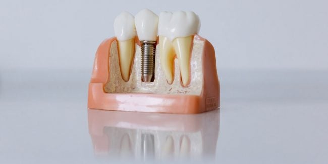 dr_ricardo_lugao_processo_de_instalacao_dos_implantes_dentarios O implante dentário é um procedimento simples que tem o objetivo de restabelecer o seu sorriso de modo estético e funcional.