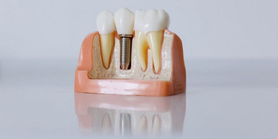 O implante dentário é um procedimento simples que tem o objetivo de restabelecer o seu sorriso de modo estético e funcional.