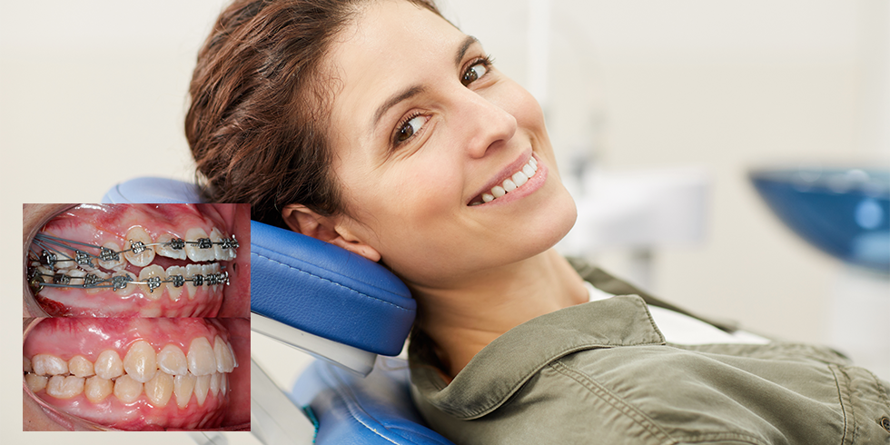 distalizacao-dos-molares-sistema-ertty