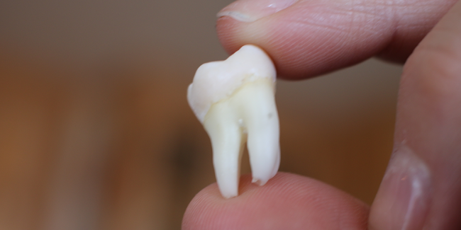 Dente-Siso-Quando-é-Necessário-Extrair